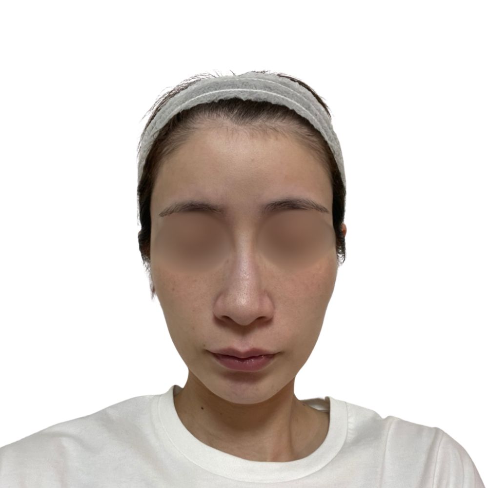 ハイフ/ウルトラセルZi