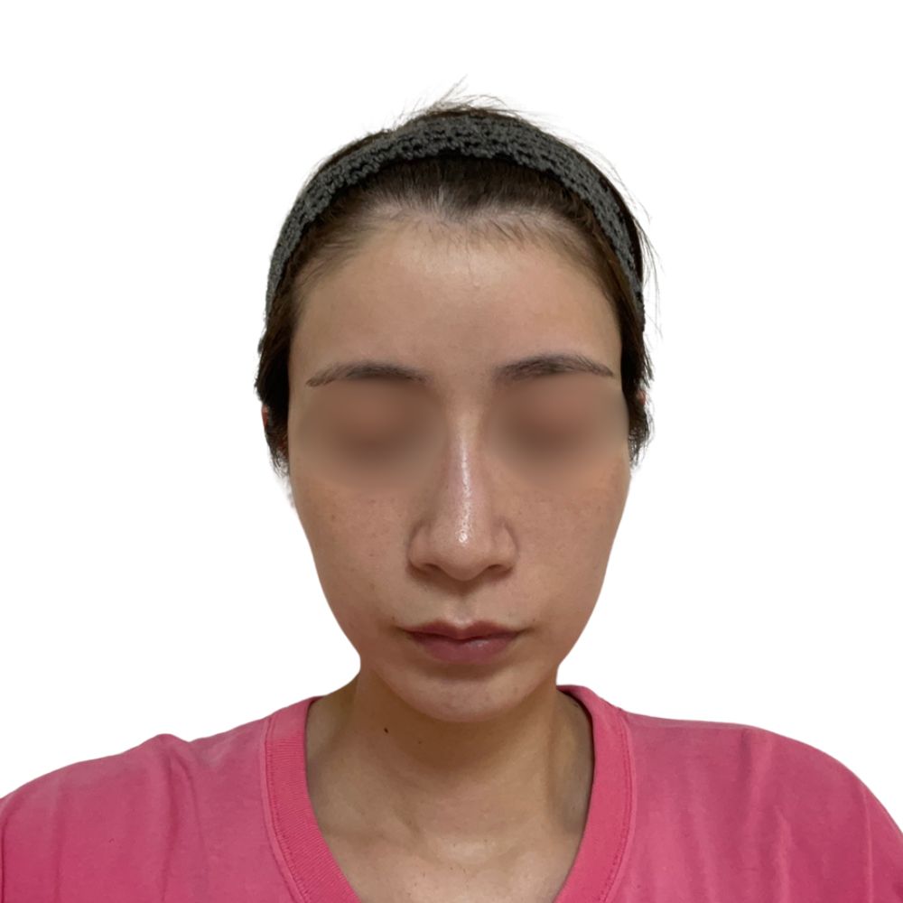 ハイフ/ウルトラセルZi