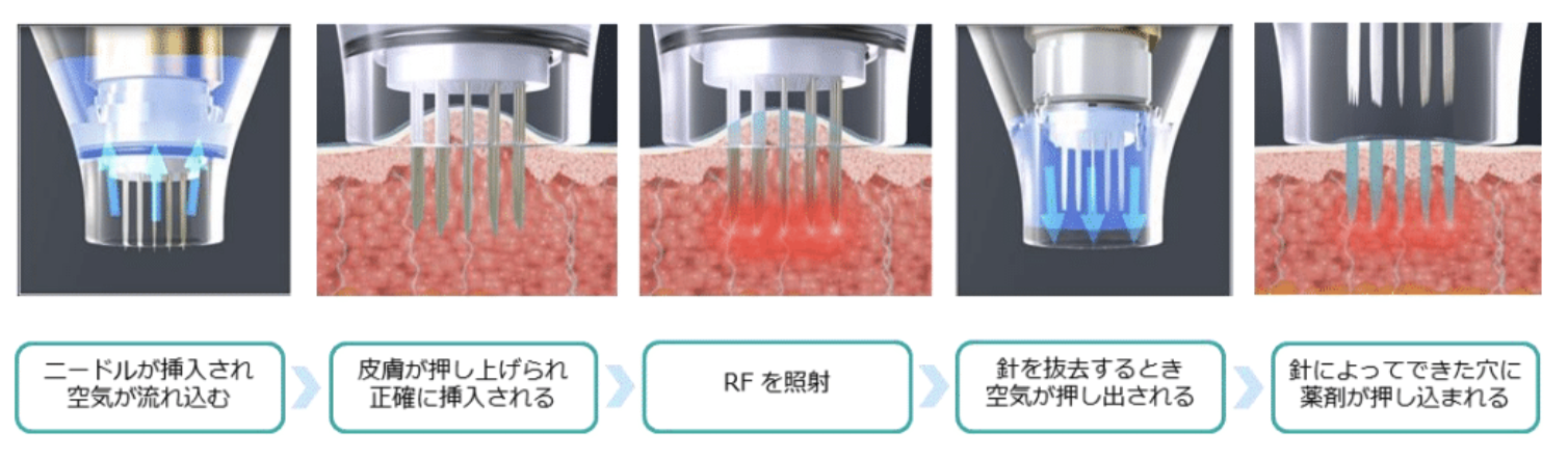 真皮層まで薬剤を届けるドラッグデリバリーシステム搭載