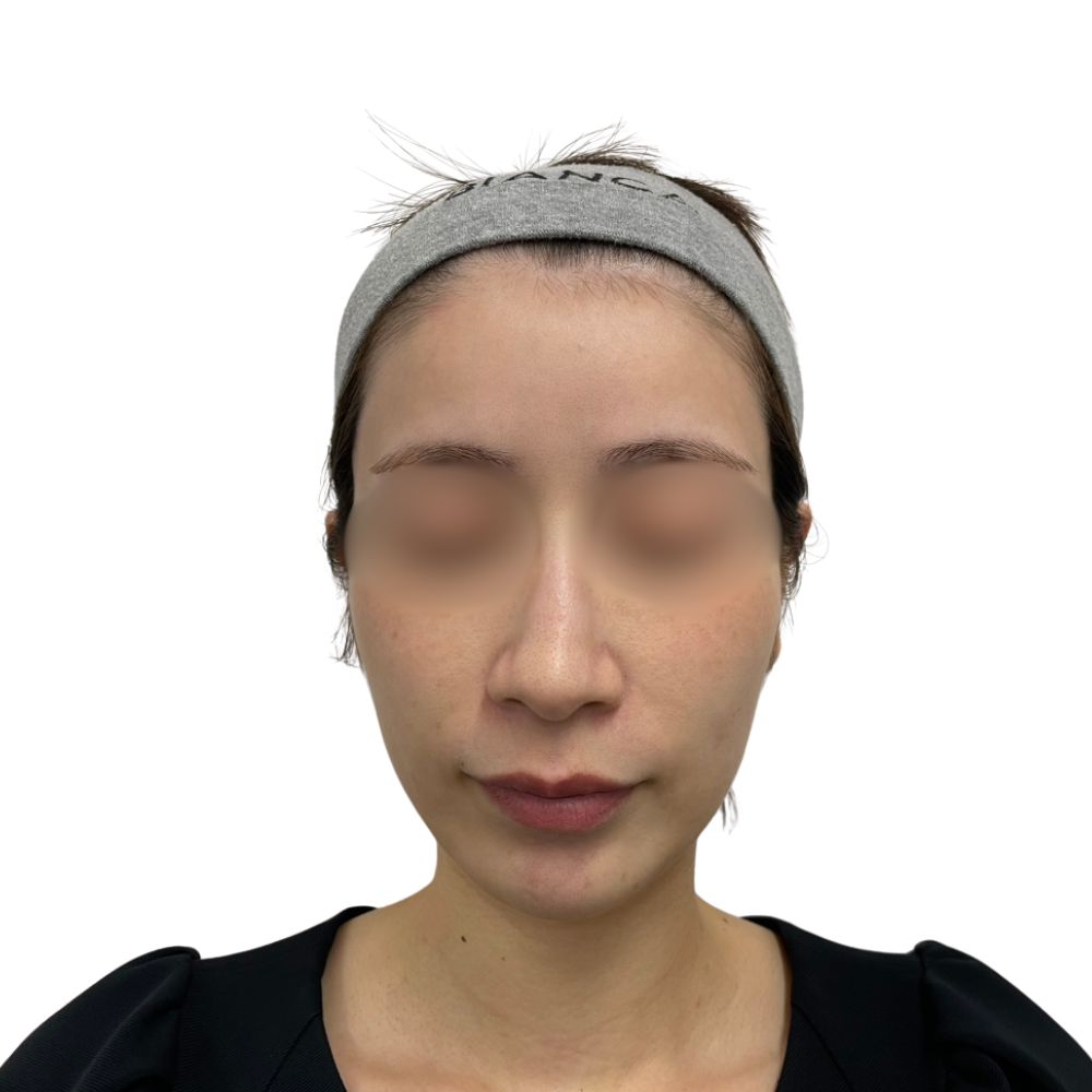 ハイフ/ウルトラセルZi