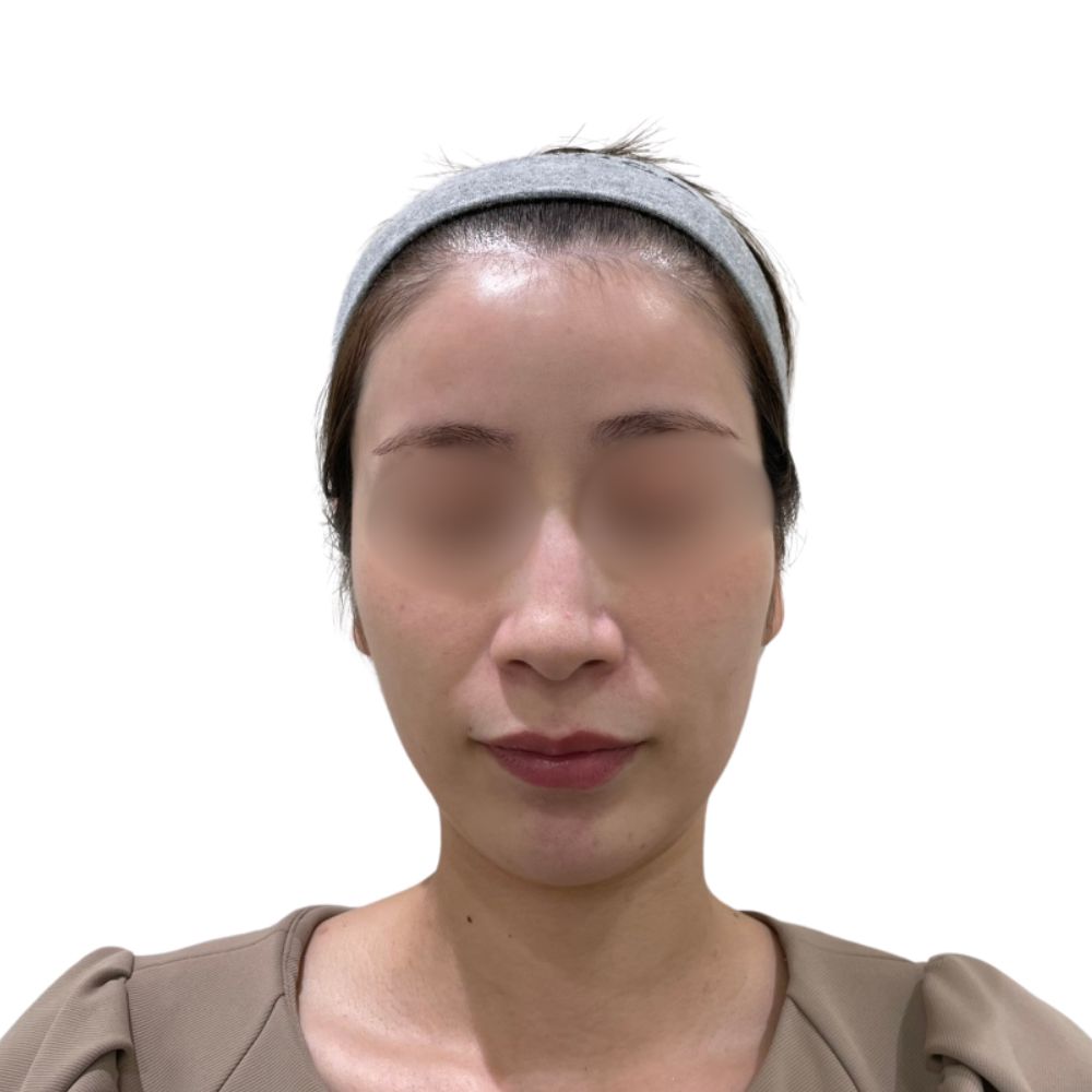 ハイフ/ウルトラセルZi