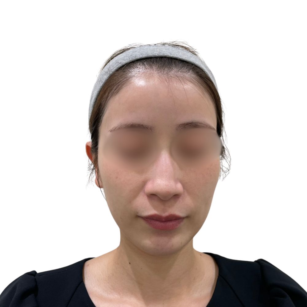 ハイフ/ウルトラセルZi