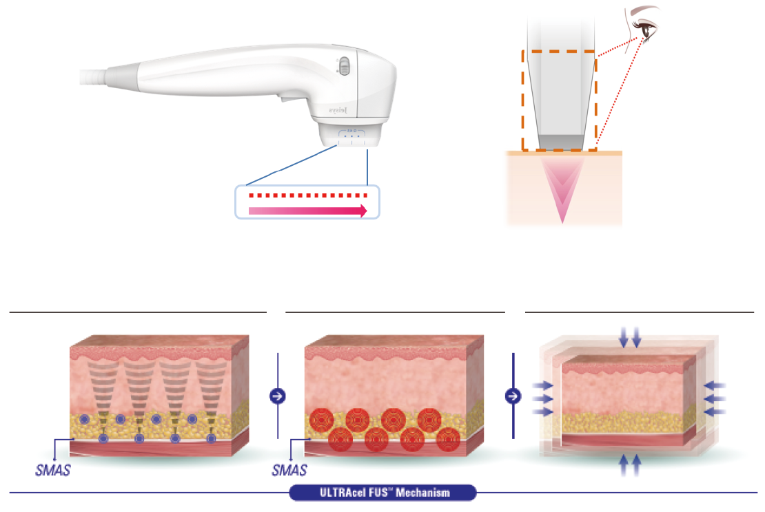 ドットモードのハイフ｜SMAS層まで熱を届けて引き締める