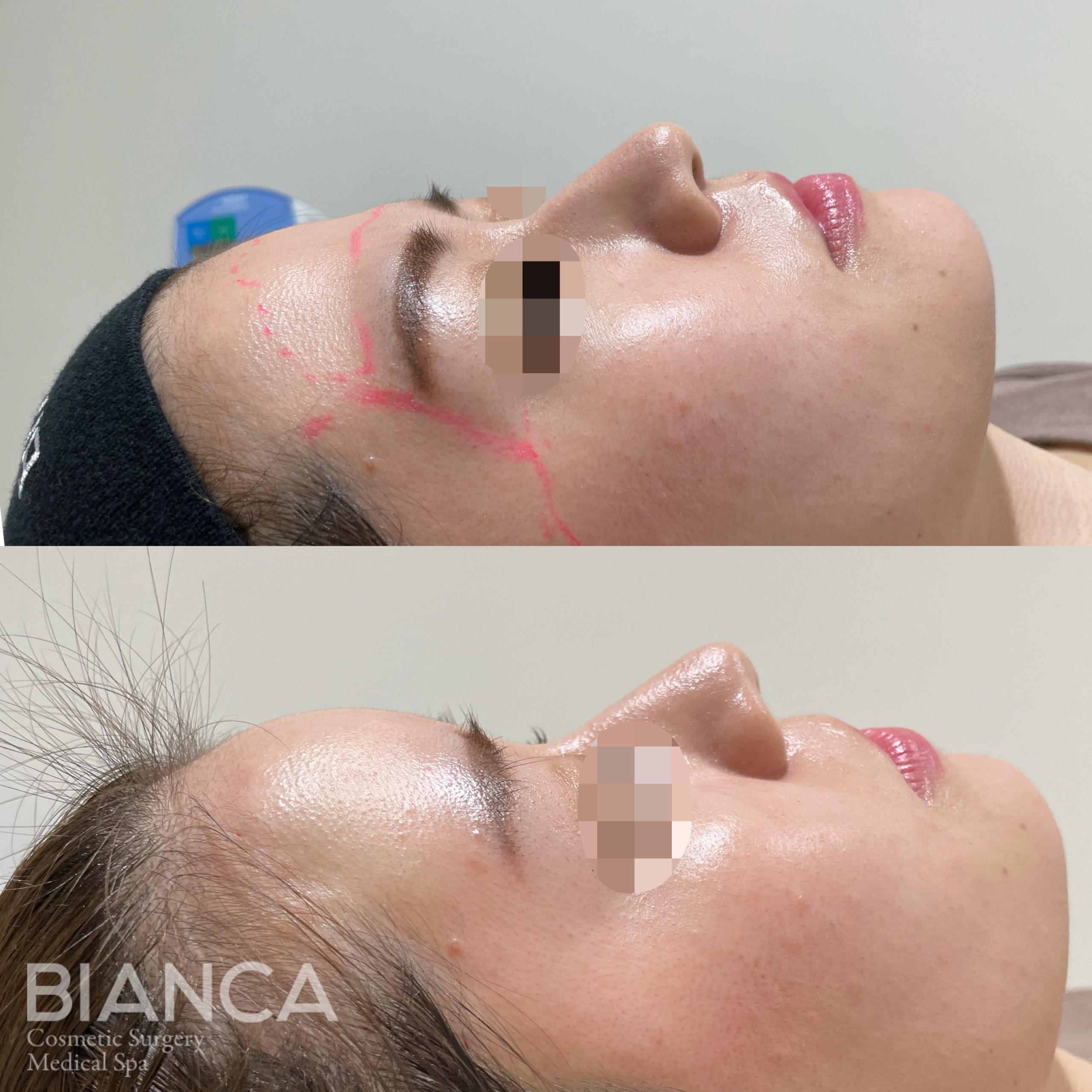 ヒアルロン酸（額）