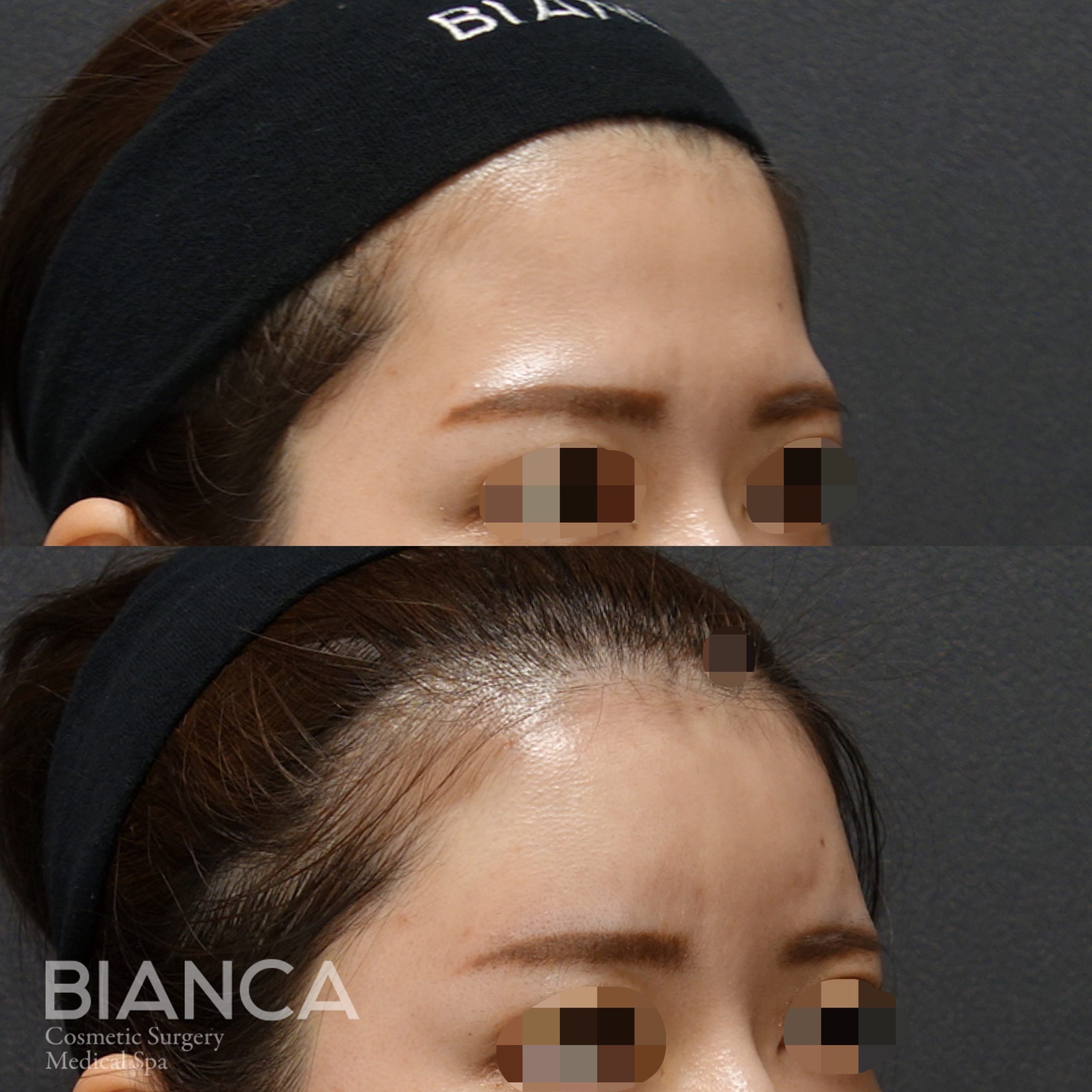 ヒアルロン酸（額）