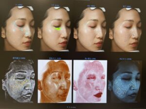 高性能肌診断機：VISIA（ビジア）｜ビアンカ銀座｜日本を代表する美容健康再生医療のクリニック