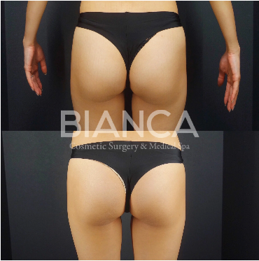 エムスカルプト（EMSCULPT）