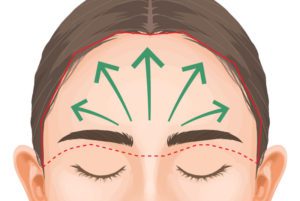 まぶたのたるみを改善するための前額リフトのイメージ