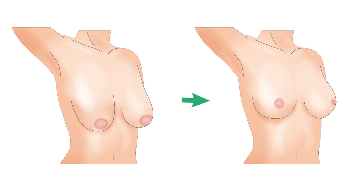 乳房吊り上げ ビアンカ銀座｜日本を代表する美容健康再生医療のクリニック