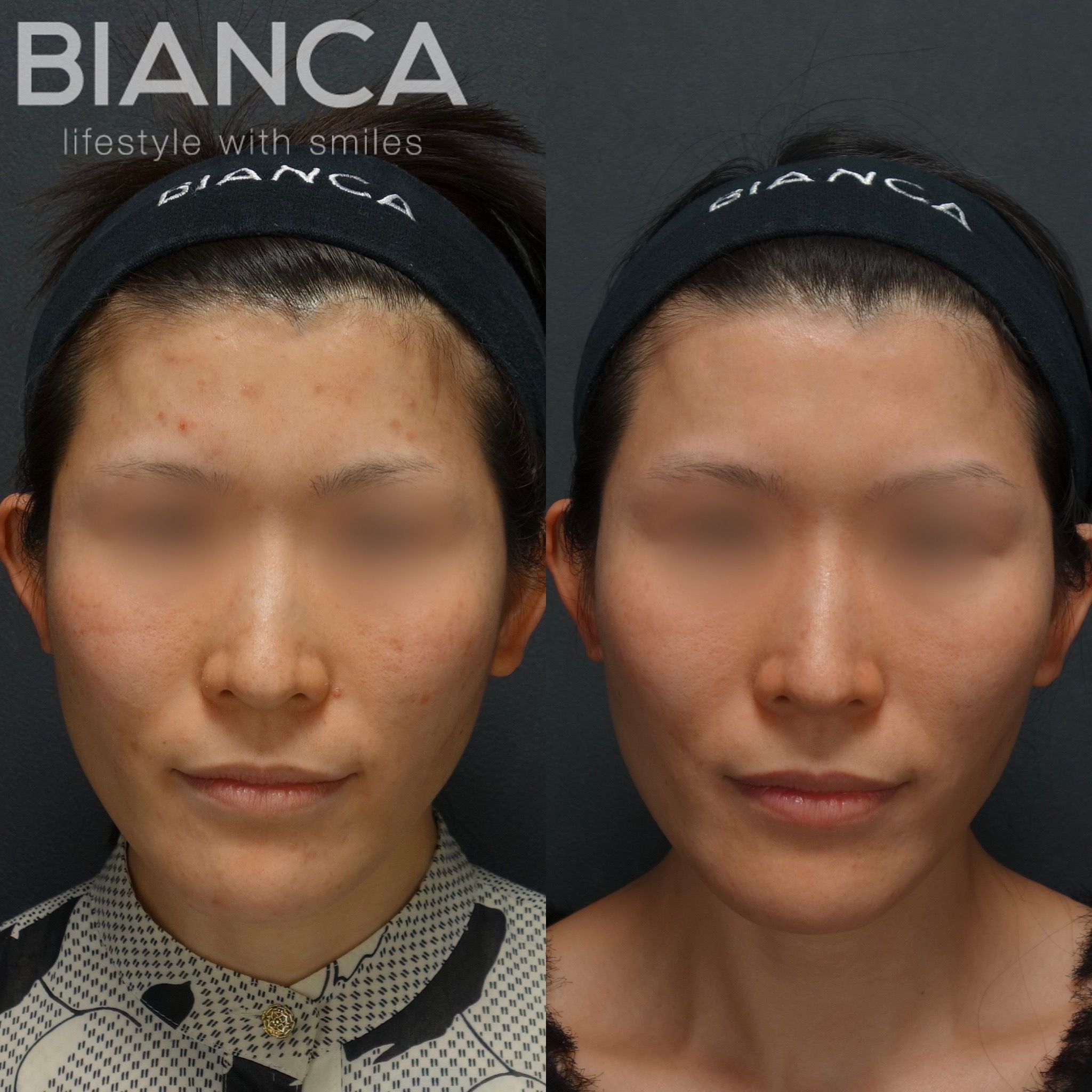 ピコスポット✖️ピコトーニング