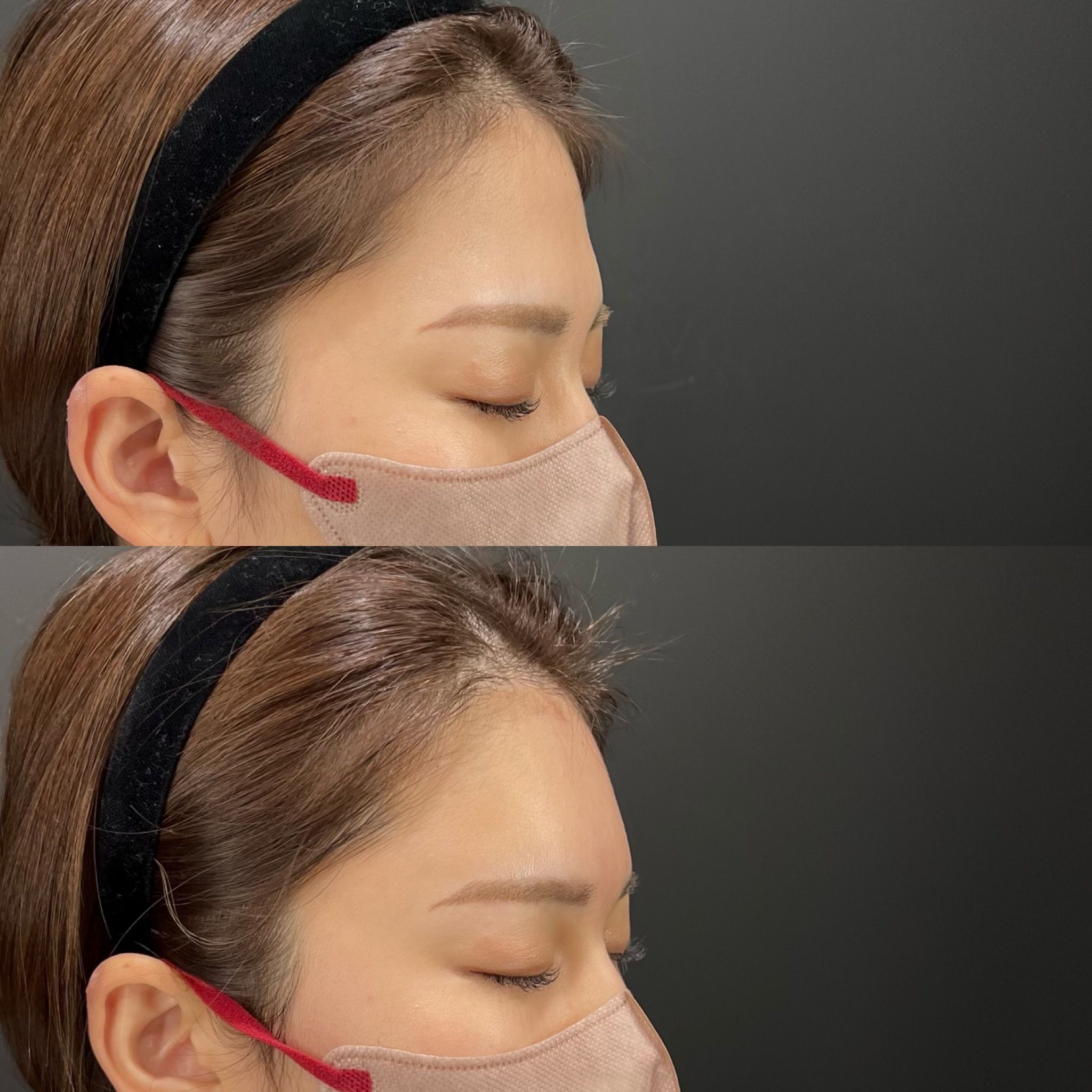 ヒアルロン酸(額)