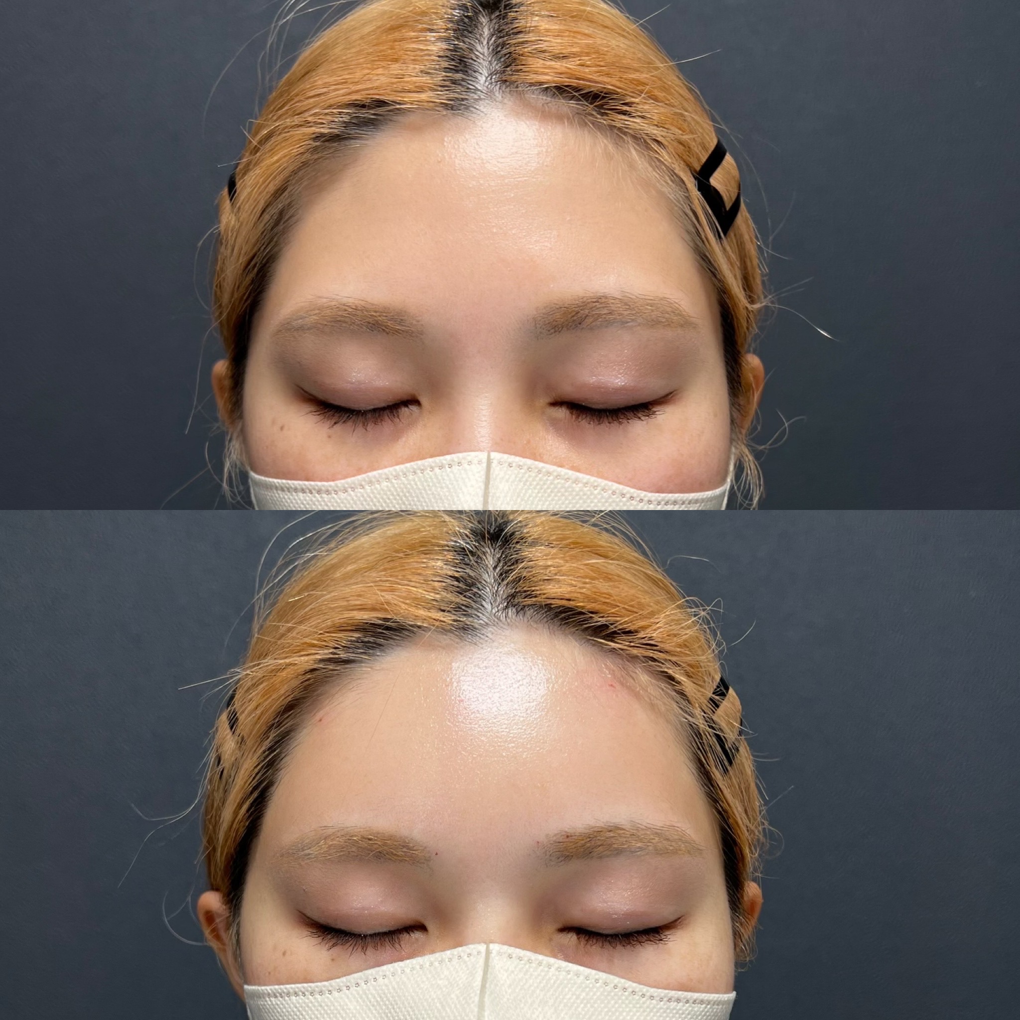 ヒアルロン酸(額)