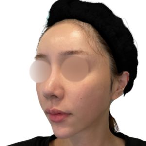 メソナJ（メソポレーション）