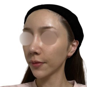 メソナJ（メソポレーション）