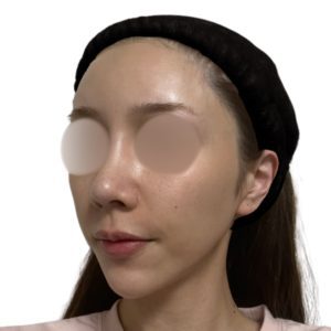 メソナJ（メソポレーション）