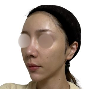 メソナJ（メソポレーション）