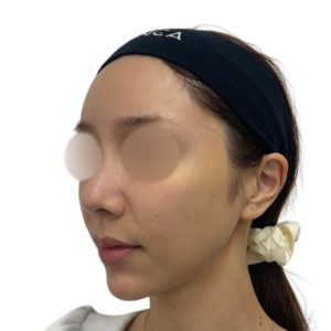 メソナJ（メソポレーション）