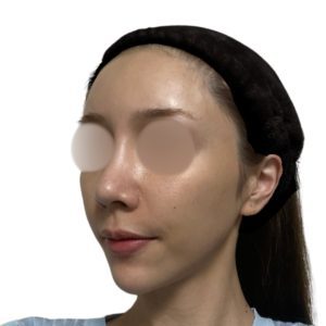 メソナJ（メソポレーション）