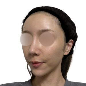 メソナJ（メソポレーション）