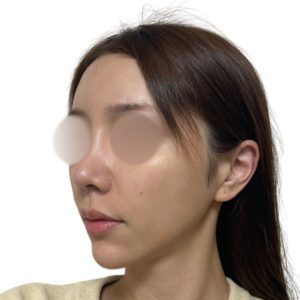 メソナJ（メソポレーション）