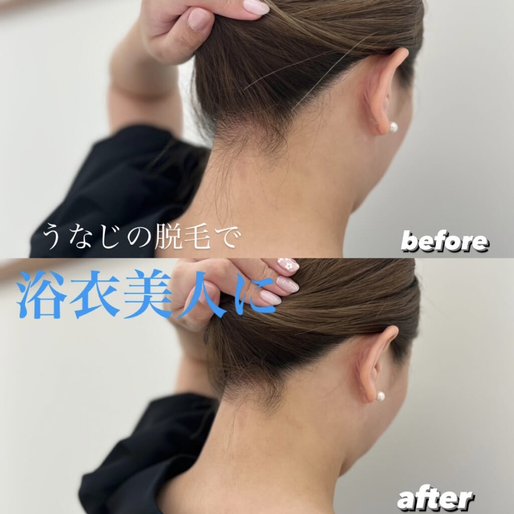 新部位うなじ脱毛追加しました✨