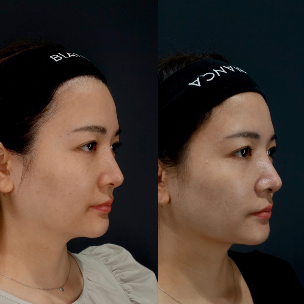 顔の脂肪吸引、VASER®（ベイザー）と従来施術の違いは？認定医・雜賀俊行先生の症例を紹介