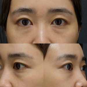 裏ハムラ　術前 裏ハムラのダウンタイムはどれくらい？腫れる？内出血・経過を医師が解説【クマ取り症例】