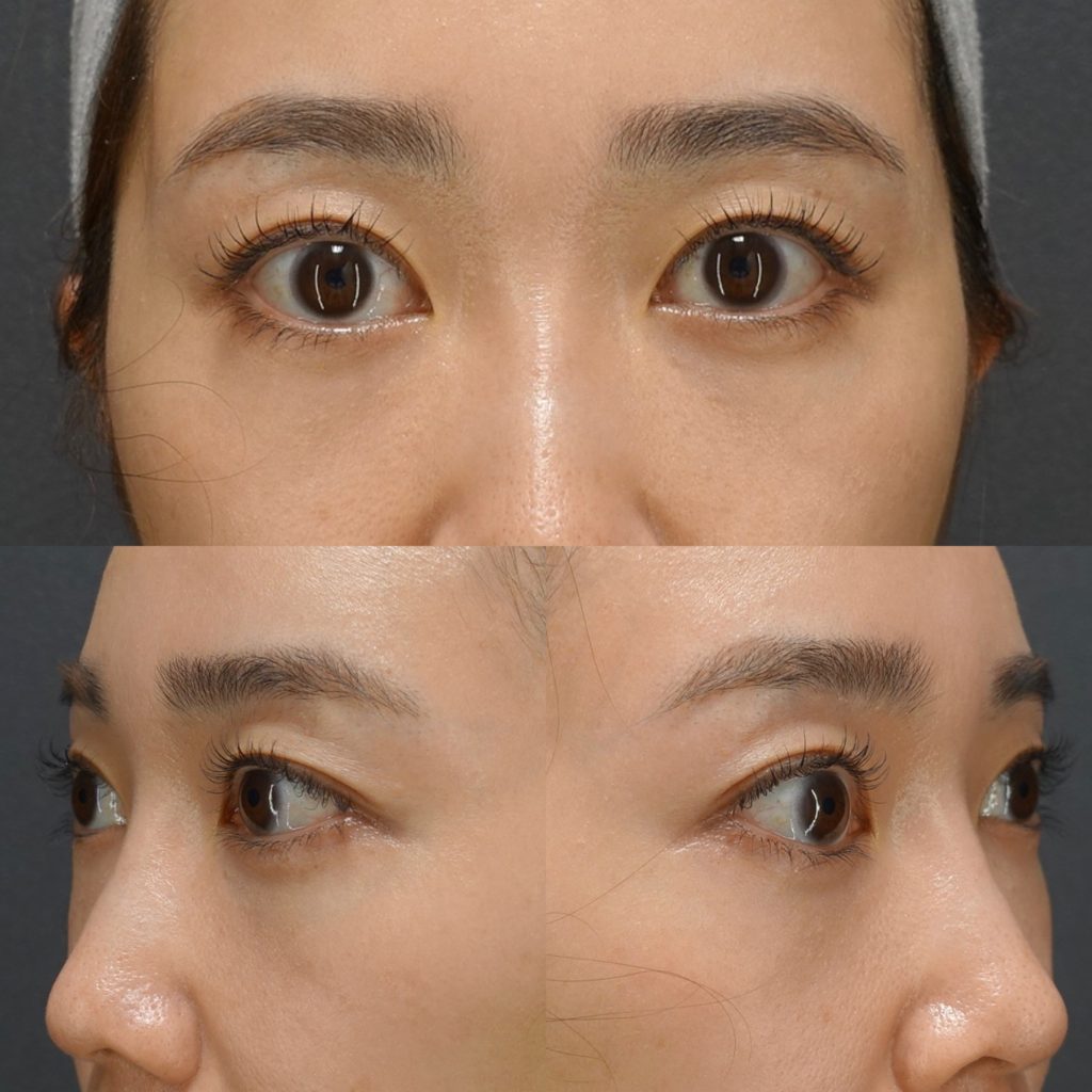 裏ハムラのダウンタイムはどれくらい？腫れる？内出血・経過を医師が解説【クマ取り症例】