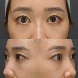 裏ハムラ　術後 裏ハムラのダウンタイムはどれくらい？腫れる？内出血・経過を医師が解説【クマ取り症例】