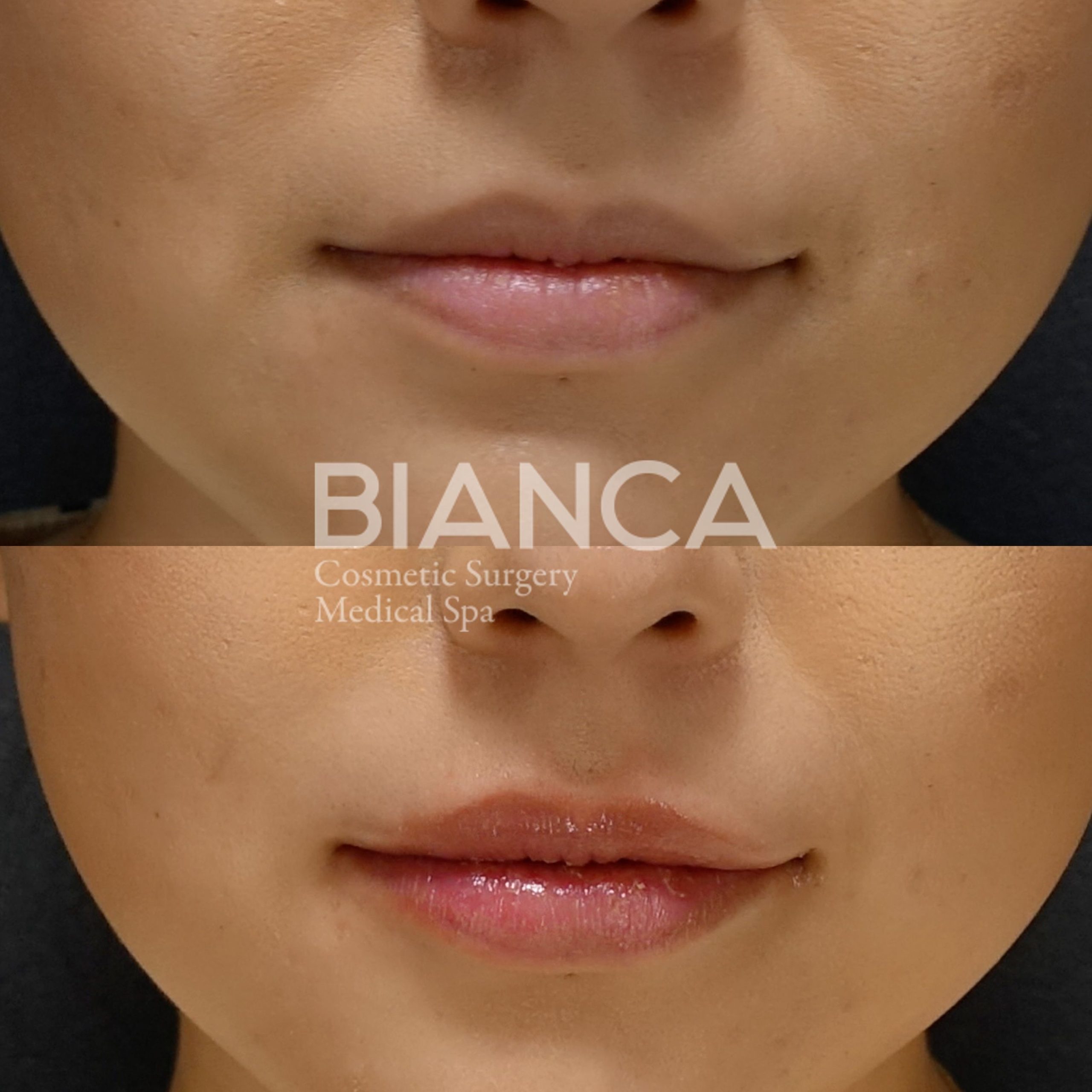 ヒアルロン酸（唇）