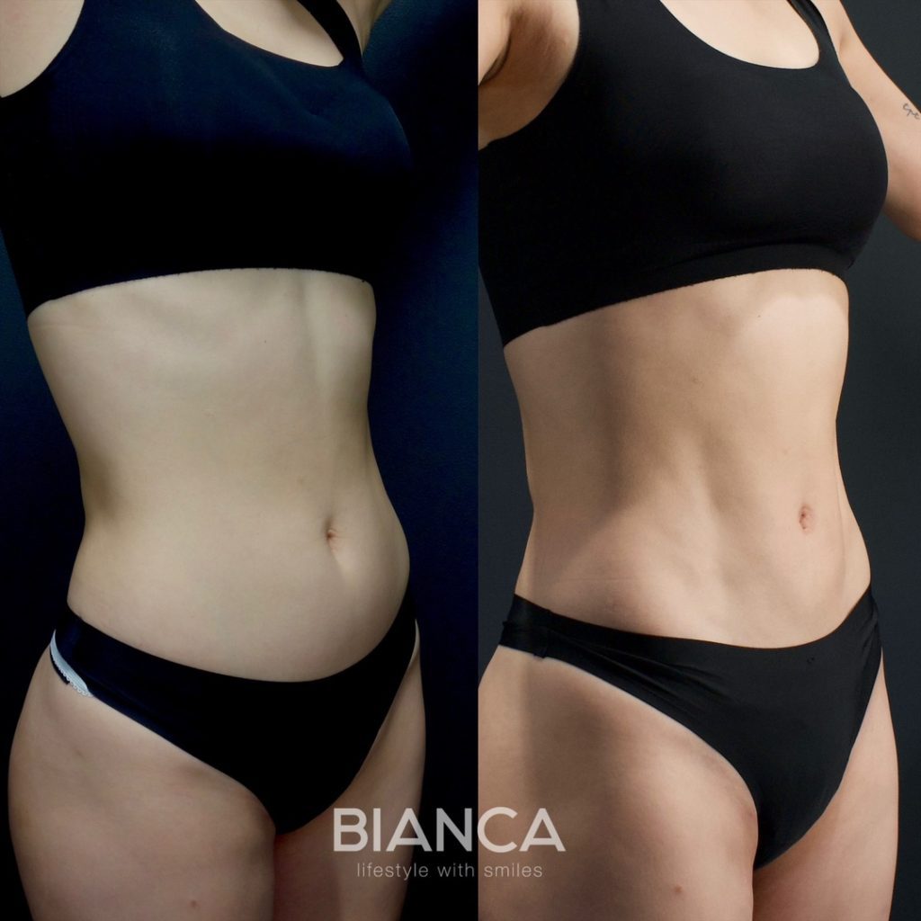 お腹の脂肪吸引に新時代！アブクラックス形成で自然な縦割れ腹筋を手に入れる【症例解説】