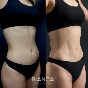 お腹の脂肪吸引に新時代！アブクラックス形成で自然な縦割れ腹筋を手に入れる【症例解説】 お腹の脂肪吸引 アブクラックス形成　術後3ヶ月