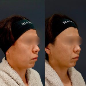 脂肪吸引 顔 小顔アンチエイジング