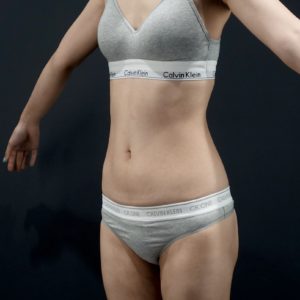 お腹の脂肪吸引術前