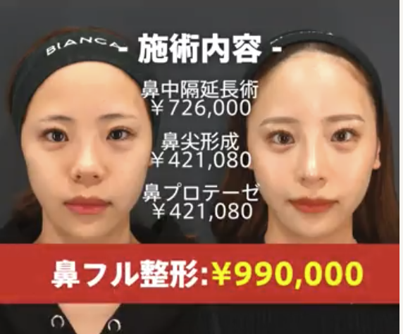 お得なモニターキャンペーン✨鼻フル99万円🉐❣️