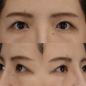 眉下切開　術後-二重幅を広げるには？眉下切開で上まぶたをスッキリ！【症例紹介】