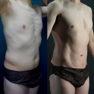 お腹の脂肪吸引 アブクラックスBeforeAfter