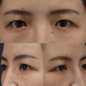 眉下切開 術前-二重幅を広げるには？眉下切開で上まぶたをスッキリ！【症例紹介】