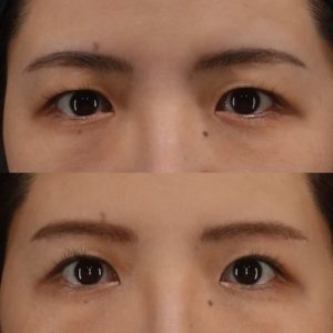二重幅を広げるには？眉下切開で上まぶたをスッキリ！【症例紹介】