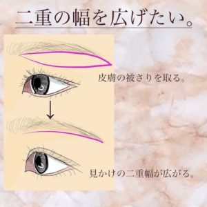 二重幅を広げる方法-二重幅を広げるには？眉下切開で上まぶたをスッキリ！【症例紹介】