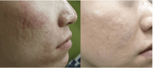 左：術前／右：3回施術、8週間後 費用：1回¥43,780～¥110,000 ※部位によって異なります。副作用・リスク：赤み、腫れ、浮腫、内出血、膨疹、むくみなど