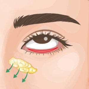 裏ハムラのダウンタイムはどれくらい？腫れる？内出血・経過を医師が解説【クマ取り症例】