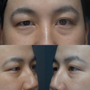 裏ハムラ二重埋没術前