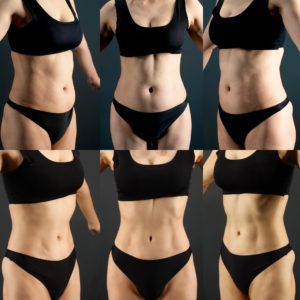 お腹の脂肪吸引 アブクラックス形成