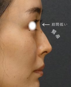 鷲鼻修正を解説！日本人ならではの特徴と症例紹介【医師監修】