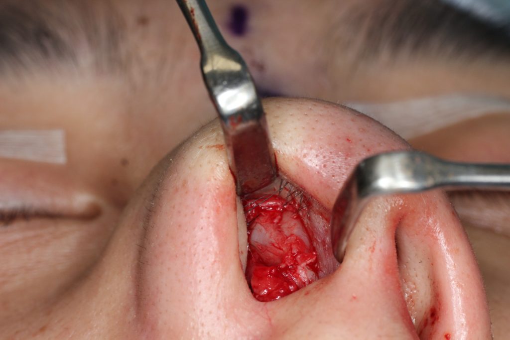 鷲鼻の手術　切り取る手術