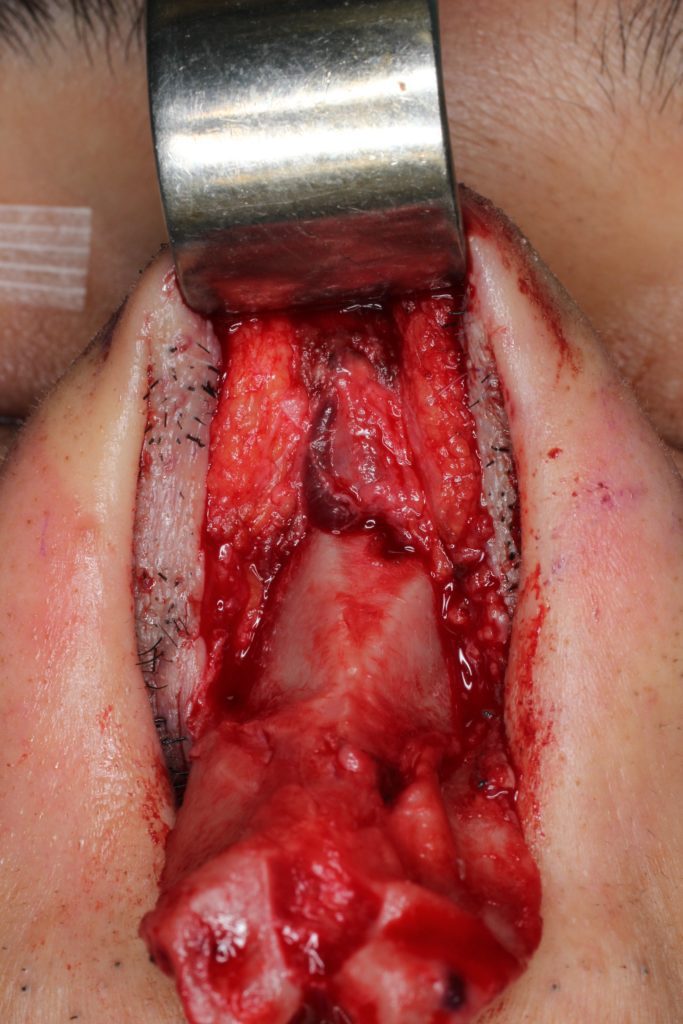 鼻ヒアルロン酸　解剖