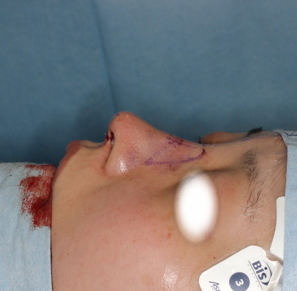 鷲鼻手術のゴールは？