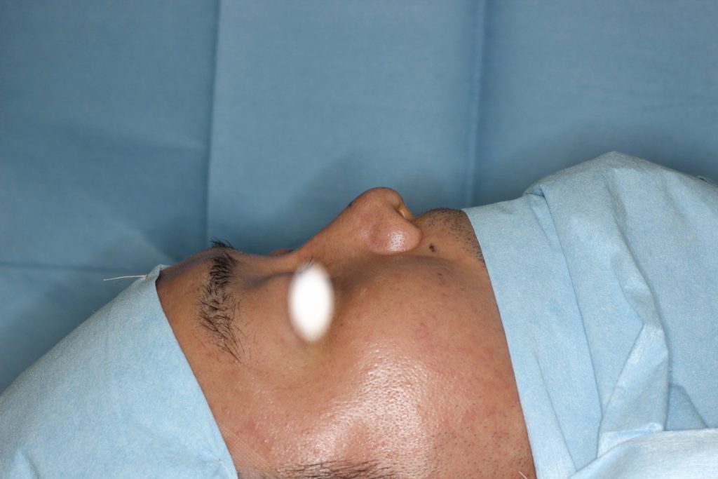 日本人は鼻先の軟骨が弱い