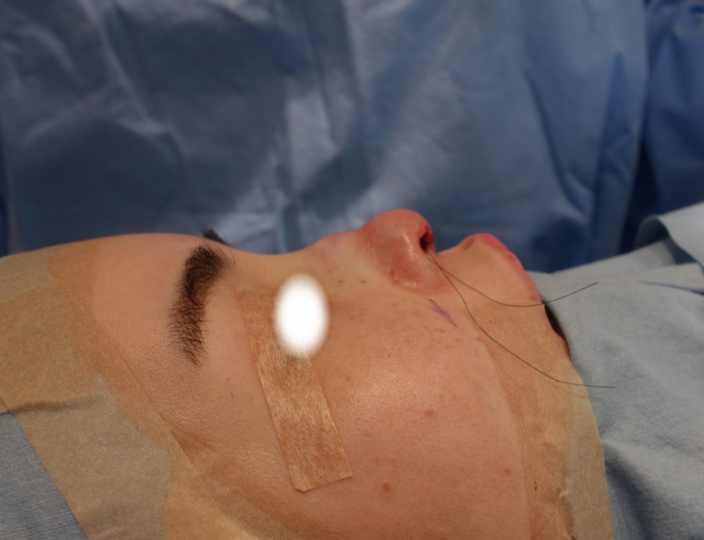 日本人の鼻先の軟骨を補強　修正症例